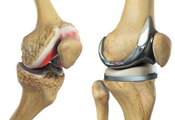 protesis rodilla2 bicos