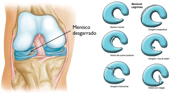 rodilla2 capio